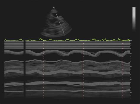How to Interpret Echocardiograms: 8 Steps (with Pictures) .